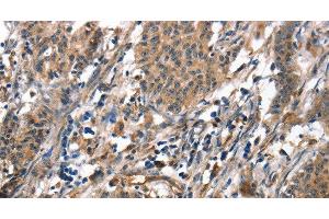 Immunohistochemistry of paraffin-embedded Human gasrtic cancer tissue using ALOX15 Polyclonal Antibody at dilution 1:50 (ALOX15 anticorps)
