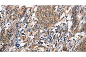 Immunohistochemistry of paraffin-embedded Human gasrtic cancer tissue using ALOX15 Polyclonal Antibody at dilution 1:50