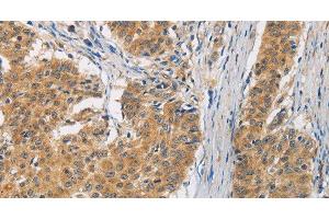 Immunohistochemistry of paraffin-embedded Human gasrtic cancer tissue using FASTK Polyclonal Antibody at dilution 1:30 (FASTK anticorps)
