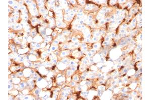 Formalin-fixed, paraffin-embedded human Hepatocellular Carcinoma stained with C1QB Mouse Monoclonal Antibody (C1QB/2966).