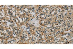 Immunohistochemistry of paraffin-embedded Human esophagus cancer using E2F6 Polyclonal Antibody at dilution of 1:60 (E2F6 anticorps)