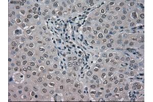 Immunohistochemical staining of paraffin-embedded Adenocarcinoma of colon tissue using anti-BUB1Bmouse monoclonal antibody. (BUB1B anticorps)