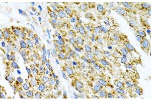 Immunohistochemistry of paraffin-embedded Human lung cancer using CYP1A1 Polyclonal Antibody at dilution of 1:100 (40x lens).