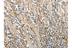 The image on the left is immunohistochemistry of paraffin-embedded Human gastric cancer tissue using ABIN7130695(PRCP Antibody) at dilution 1/20, on the right is treated with fusion protein. (PRCP anticorps)