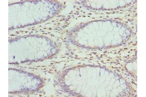 Immunohistochemistry of paraffin-embedded human colon cancer using ABIN7176343 at dilution of 1:100 (ZNF546 anticorps  (AA 101-400))