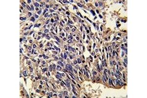 IHC analysis of FFPE human lung carcinoma stained with IL-1 antibody (IL1A anticorps  (AA 177-206))