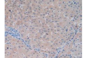 IHC-P analysis of Human Liver Cancer Tissue, with DAB staining. (Vitamin D-Binding Protein anticorps  (AA 209-401))
