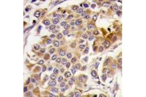 Formalin-fixed and paraffin-embedded human breast carcinoma tissue reacted with PRKAA1, which was peroxidase-conjugated to the secondary antibody, followed by DAB staining. (PRKAA1 anticorps  (Ser487))