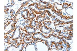 The image on the left is immunohistochemistry of paraffin-embedded Human thyroid cancer tissue using (TLR2 Antibody) at dilution 1/30, on the right is treated with fusion protein. (TLR2 anticorps)