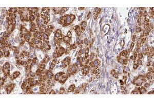 ABIN6278182 at 1/100 staining Human liver cancer tissue by IHC-P. (P2RX7 anticorps  (C-Term))