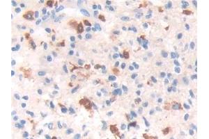 Detection of IFI30 in Human Glioma Tissue using Polyclonal Antibody to Interferon Gamma Inducible Protein 30 (IFI30)