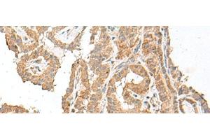 Immunohistochemistry of paraffin-embedded Human thyroid cancer tissue using GART Polyclonal Antibody at dilution of 1:30(x200) (GART anticorps)