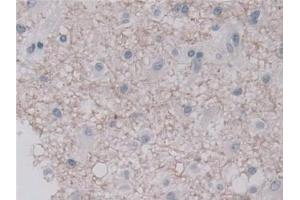 Detection of UNG in Human Glioma Tissue using Polyclonal Antibody to Uracil DNA Glycosylase (UNG)