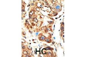 Formalin-fixed and paraffin-embedded human hepatocellular carcinoma tissue reacted with MAGI1 polyclonal antibody  , which was peroxidase-conjugated to the secondary antibody, followed by AEC staining. (MAGI1 anticorps  (C-Term))