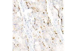 Immunohistochemistry of paraffin-embedded human colon carcinoma using Perilipin-2 antibody (ABIN7269220) at dilution of 1:1600 (40x lens). (ADRP anticorps)