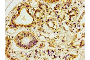 IHC image of ABIN7147154 diluted at 1:100 and staining in paraffin-embedded human breast cancer performed on a Leica BondTM system. (CD31 anticorps  (AA 28-315))