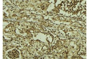 ABIN6267212 at 1/100 staining Human breast cancer tissue by IHC-P. (CDK6 anticorps  (pTyr13))