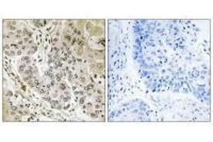 Immunohistochemistry analysis of paraffin-embedded human lung carcinoma tissue, using STK36 antibody. (STK36 anticorps)