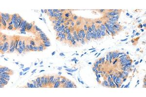 Immunohistochemistry of paraffin-embedded Human colon cancer tissue using GLUT-4 Polyclonal Antibody at dilution 1:70 (GLUT4 anticorps)