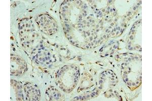 Immunohistochemistry of paraffin-embedded human breast cancer using ABIN7152130 at dilution of 1:100 (EIF1AX anticorps  (AA 10-144))