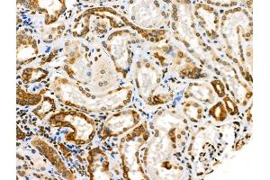 Phospho-Cytokeratin 18 (Ser53) Antibody at 1/100 staining Human kidney cancer and adjacent normal tissues by IHC-P. (Cytokeratin 18 anticorps  (pSer53))