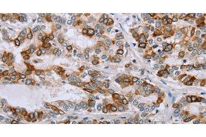 Immunohistochemistry of paraffin-embedded Human liver cancer tissue using NMT1 Polyclonal Antibody at dilution 1:45