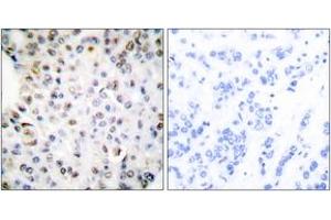 Immunohistochemistry analysis of paraffin-embedded human breast carcinoma tissue, using Retinoid X Receptor gamma Antibody. (Retinoid X Receptor gamma anticorps  (AA 171-220))
