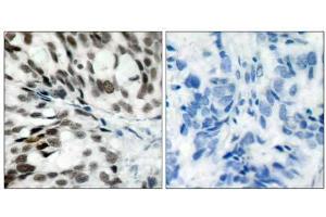 Immunohistochemical analysis of paraffin- embedded human breast carcinoma tissue using Rb (Ab-780) antibody (E021110). (Retinoblastoma 1 anticorps)