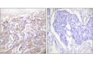 Immunohistochemistry analysis of paraffin-embedded human breast carcinoma tissue, using TNF Receptor I Antibody.