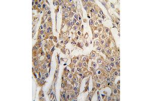 Formalin-fixed and paraffin-embedded human breast carcinoma tissue reacted with PKM2 antibody (C-term ) (ABIN391256 and ABIN2841316) , which was peroxidase-conjugated to the secondary antibody, followed by DAB staining. (PKM2 anticorps  (C-Term))
