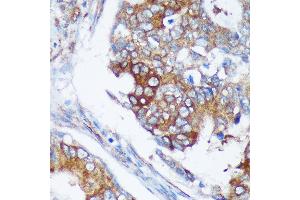 Immunohistochemistry of paraffin-embedded Human colon carcinoma using R Rabbit pAb (ABIN7269785) at dilution of 1:100 (40x lens). (RABGAP1 anticorps  (AA 830-1069))