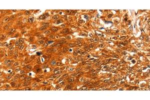 Immunohistochemistry of paraffin-embedded Human esophagus cancer using SERPINB5 Polyclonal Antibody at dilution of 1:60 (SERPINB5 anticorps)