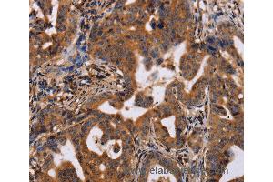 Immunohistochemistry of Human prostate cancer using IL12RB2 Polyclonal Antibody at dilution of 1:40 (IL12RB2 anticorps)