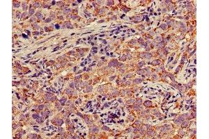 IHC image of ABIN7150697 diluted at 1:300 and staining in paraffin-embedded human pancreatic cancer performed on a Leica BondTM system.