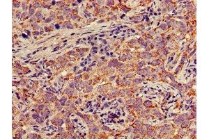 IHC image of ABIN7150697 diluted at 1:300 and staining in paraffin-embedded human pancreatic cancer performed on a Leica BondTM system. (MEK1 anticorps  (AA 2-79))