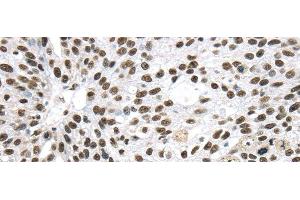 Immunohistochemistry of paraffin-embedded Human breast cancer using DDX39B Polyclonal Antibody at dilution of 1/40 (DDX39B anticorps)