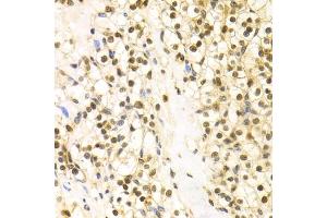 Immunohistochemistry of paraffin-embedded human kidney cancer using BAG1 Antibody (ABIN5970457) at dilution of 1/100 (40x lens). (BAG1 anticorps)