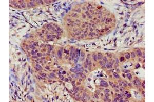 Immunohistochemistry of paraffin-embedded human colon cancer using ABIN7169527 at dilution of 1:100