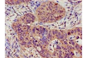 Immunohistochemistry of paraffin-embedded human colon cancer using ABIN7169527 at dilution of 1:100 (TRPC1 anticorps  (AA 39-207))
