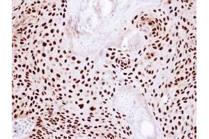 IHC-P Image Immunohistochemical analysis of paraffin-embedded Cal27 Xenograft, using Ku80 (XRCC5), antibody at 1:100 dilution. (X-Ray Repair Cross Complementing 5 anticorps)