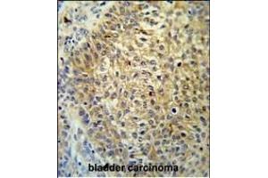 T Antibody (Center) (ABIN651323 and ABIN2840187) IHC analysis in formalin fixed and paraffin embedded bladder carcinoma followed by peroxidase conjugation of the secondary antibody and DAB staining. (TMEM222 anticorps  (AA 107-135))