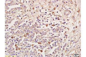 Formalin-fixed and paraffin embedded human pulmonitis labeled with Anti-IL-18R Beta/IL1R7/CD218b Polyclonal Antibody, Unconjugated (ABIN748058) at 1:200 followed by conjugation to the secondary antibody and DAB staining