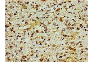 Immunohistochemistry of paraffin-embedded human glioma using ABIN7156245 at dilution of 1:100