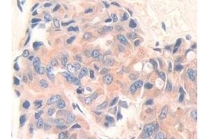 Detection of DEP1 in Human Breast cancer Tissue using Polyclonal Antibody to Density Enhanced Phosphatase 1 (DEP1) (PTPRJ anticorps  (AA 1061-1293))