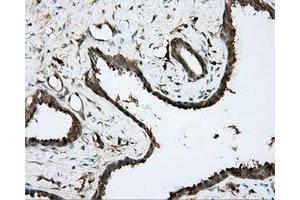 Immunohistochemical staining of paraffin-embedded Carcinoma of prostate tissue using anti-BTK mouse monoclonal antibody. (BTK anticorps)