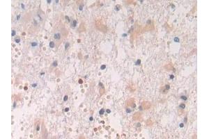 Detection of SPON2 in Human Glioma Tissue using Polyclonal Antibody to Spondin 2 (SPON2)