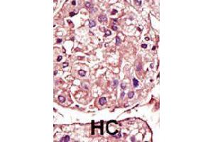 Formalin-fixed and paraffin-embedded human hepatocellular carcinoma tissue reacted with TGFBR1 polyclonal antibody  , which was peroxidase-conjugated to the secondary antibody, followed by AEC staining. (TGFBR1 anticorps  (Internal Region))