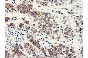 Immunohistochemical staining of paraffin-embedded Carcinoma of Human lung tissue using anti-EIF2B3 mouse monoclonal antibody.
