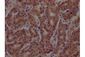 IHC image of ABIN7148794 diluted at 1:200 and staining in paraffin-embedded human breast cancer performed on a Leica BondTM system. (ATF4 anticorps  (AA 20-200))