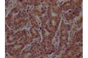IHC image of ABIN7148794 diluted at 1:200 and staining in paraffin-embedded human breast cancer performed on a Leica BondTM system.